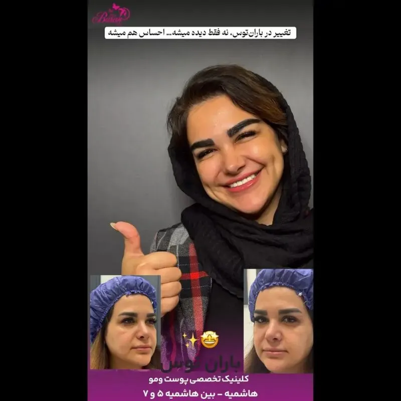 نمونه کار میکروکاشت ابرو در مشهد